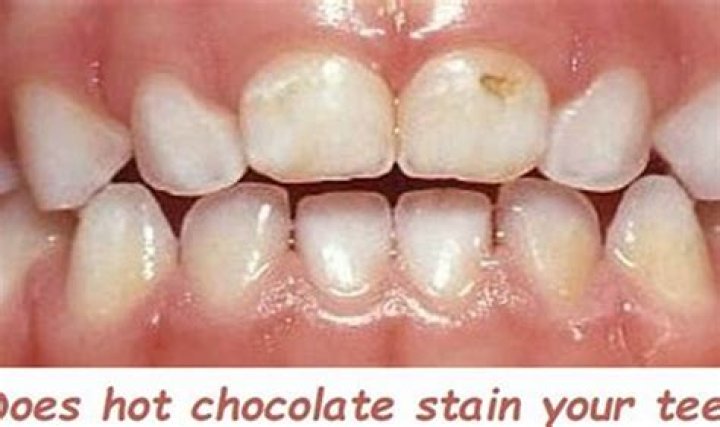 Can chocolate stain your teeth?
