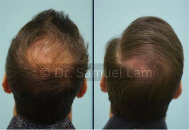 Can you reverse androgenic alopecia?