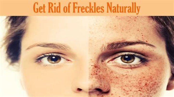 Do lip freckles go away?