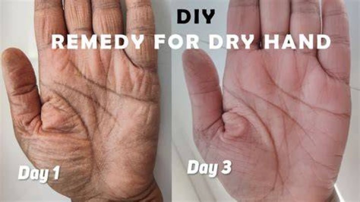 How do you soften hard knuckles?