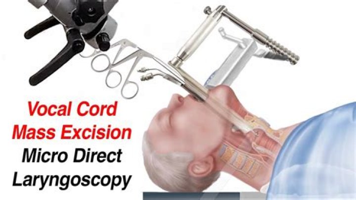 What are the two most common indications for Microlaryngoscopy?