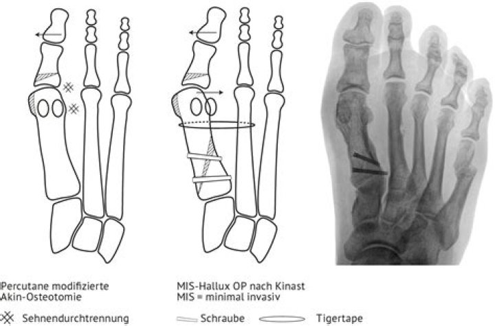 Wie lange dauert der Heilungsprozess nach einer Hallux OP?